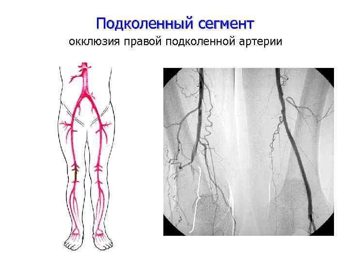 Подколенный сегмент окклюзия правой подколенной артерии 