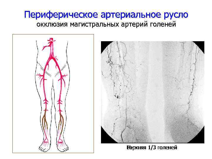 Периферическое артериальное русло окклюзия магистральных артерий голеней Верхняя 1/3 голеней Нижняя 