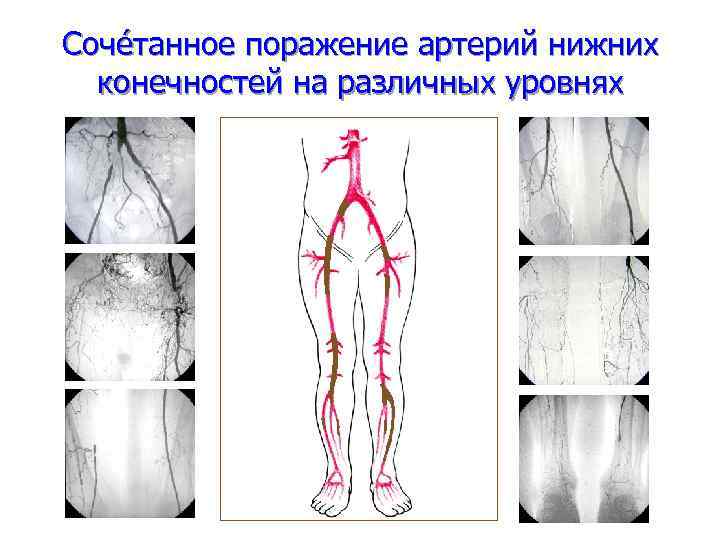 Артерии нижних конечностей фото