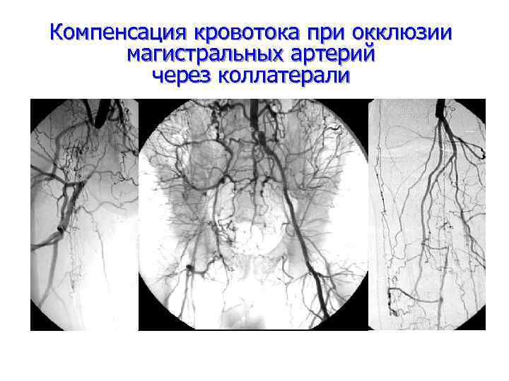 Компенсация кровотока при окклюзии магистральных артерий через коллатерали 