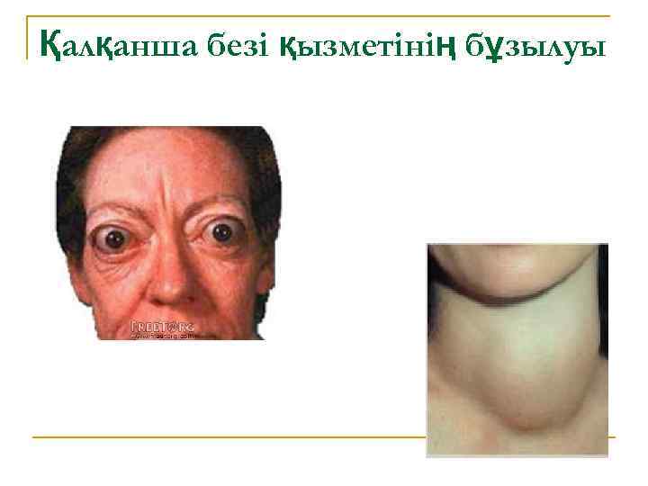 Қалқанша безі қызметінің бұзылуы 