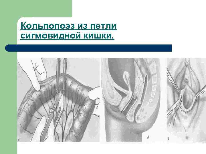 Кольпопоэз из петли сигмовидной кишки. 