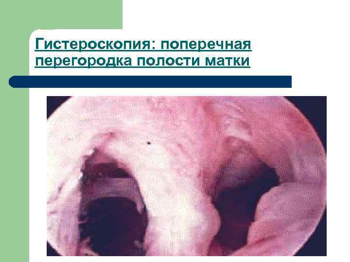 Гистероскопия: поперечная перегородка полости матки 