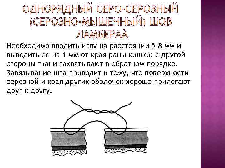 Необходимо вводить иглу на расстоянии 5 -8 мм и выводить ее на 1 мм