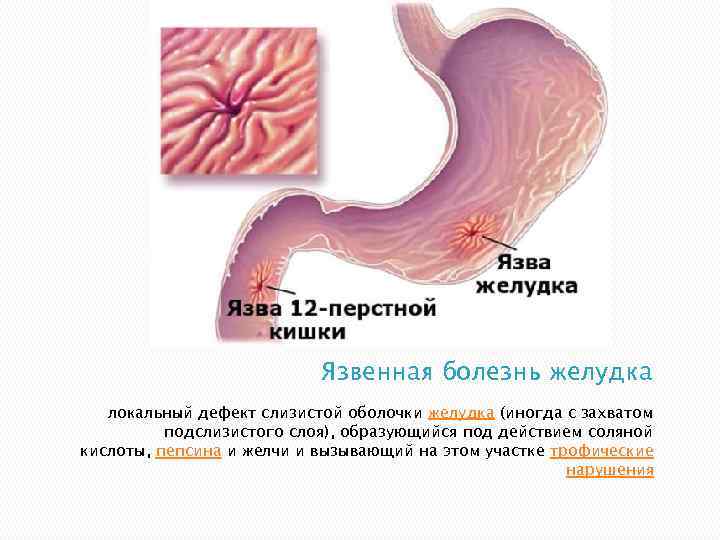 Язвенная болезнь желудка локальный дефект слизистой оболочки желудка (иногда с захватом подслизистого слоя), образующийся