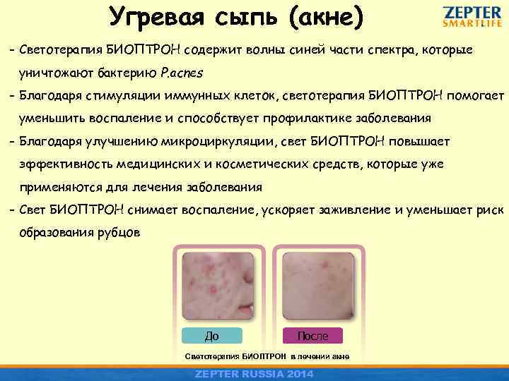 Угревая сыпь (акне) - Светотерапия БИОПТРОН содержит волны синей части спектра, которые уничтожают бактерию