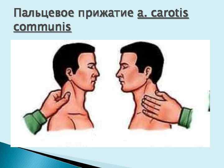 Пальцевое прижатие a. carotis communis 