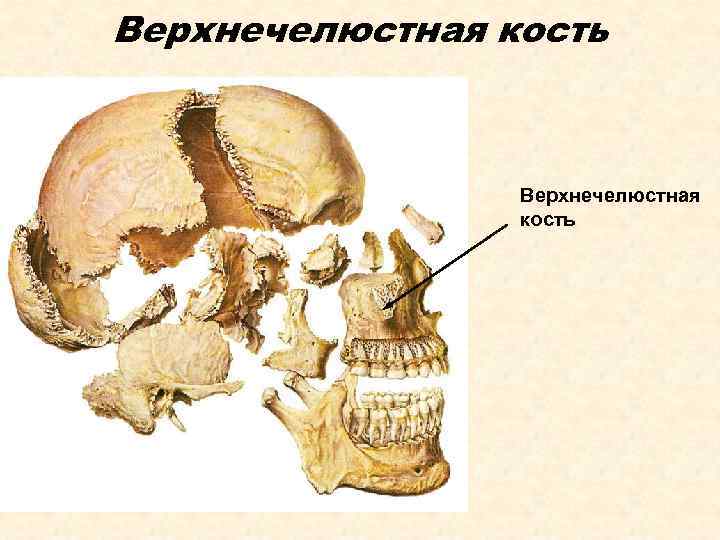 Верхнечелюстная кость 