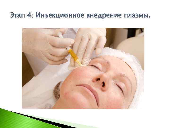 Этап 4: Инъекционное внедрение плазмы. 