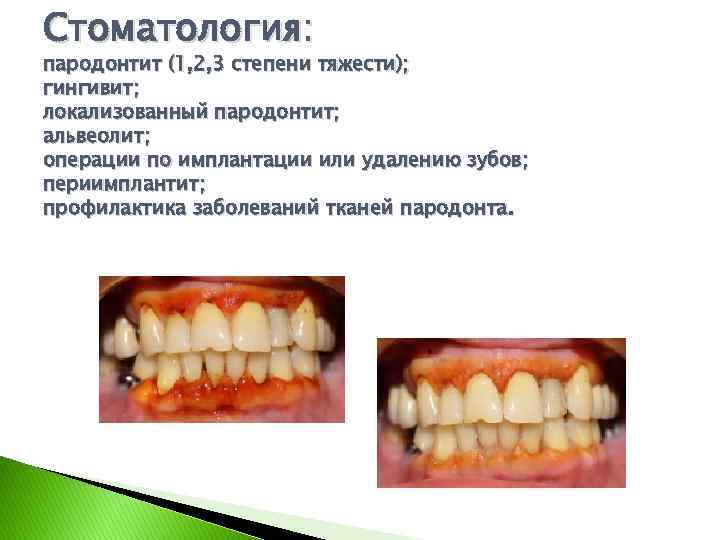 Стоматология: пародонтит (1, 2, 3 степени тяжести); гингивит; локализованный пародонтит; альвеолит; операции по имплантации