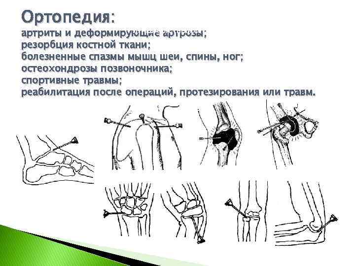 Ортопедия: ЛУЧЕЗАПЯСТНЫЙ СУСТАВ артриты и деформирующие артрозы; резорбция костной ткани; болезненные спазмы мышц шеи,