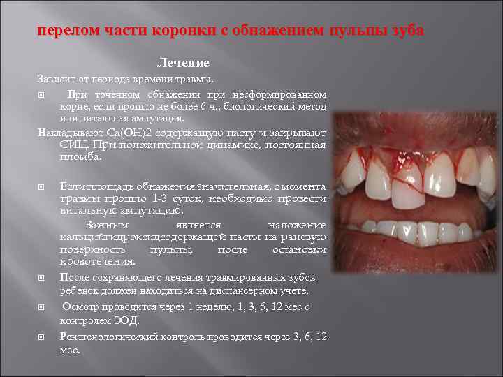 перелом части коронки с обнажением пульпы зуба Лечение Зависит от периода времени травмы. При