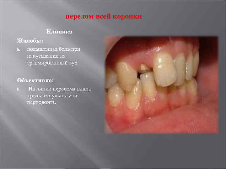 перелом всей коронки Клиника Жалобы: повышенная боль при накусывании на травмированный зуб. Объективно: На