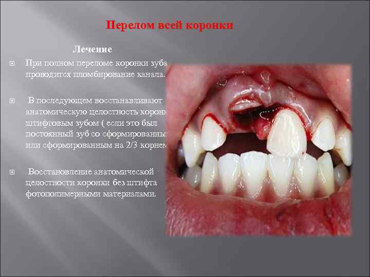 Перелом всей коронки Лечение При полном переломе коронки зуба проводится пломбирование канала. В последующем