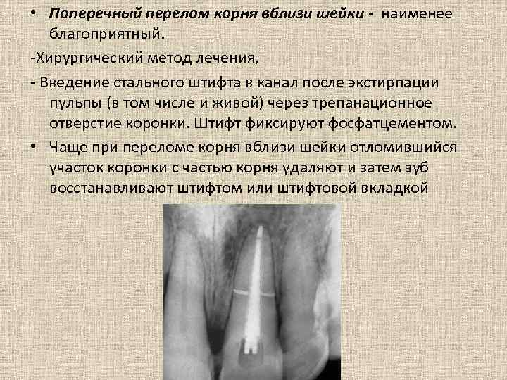  • Поперечный перелом корня вблизи шейки - наименее благоприятный. -Хирургический метод лечения, -