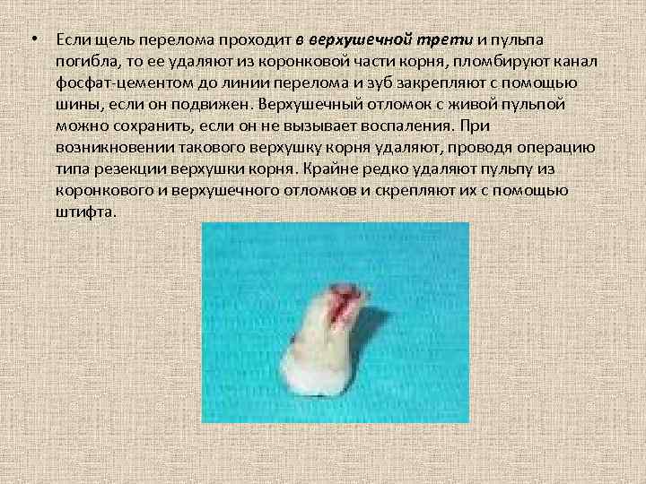  • Если щель перелома проходит в верхушечной трети и пульпа погибла, то ее