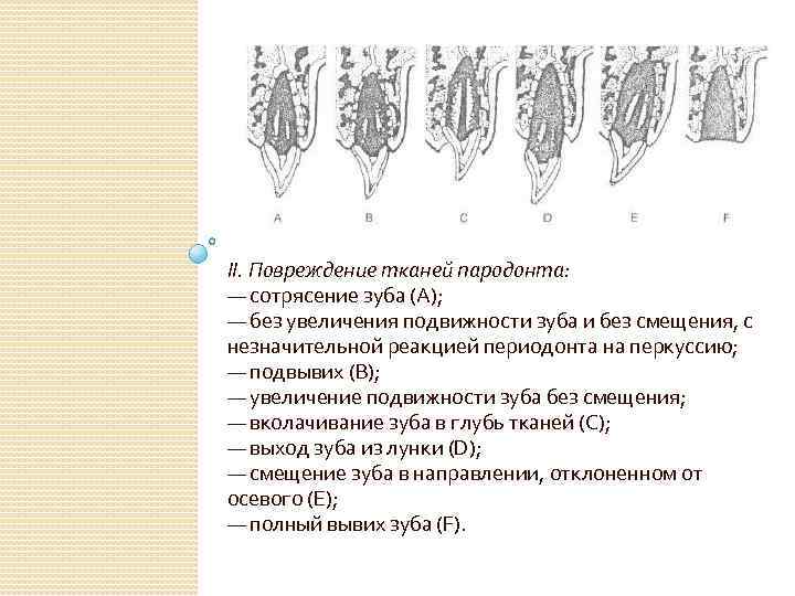 II. Повреждение тканей пародонта: — сотрясение зуба (А); — без увеличения подвижности зуба и