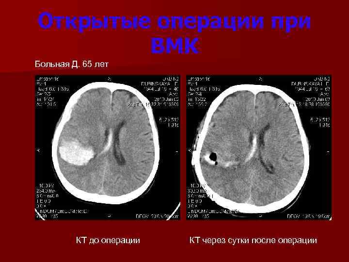 Открытые операции при ВМК Больная Д. 65 лет КТ до операции КТ через сутки