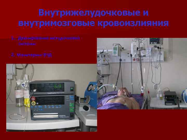 Внутрижелудочковые и внутримозговые кровоизлияния 1. Дренирование желудочковой системы 2. Мониторинг ВЧД 