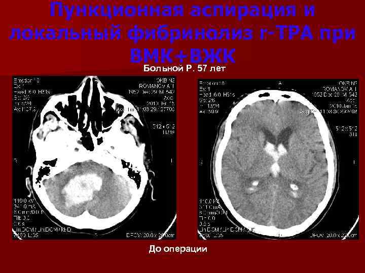 Пункционная аспирация и локальный фибринолиз r-TPA при ВМК+ВЖК Больной Р. 57 лет До операции