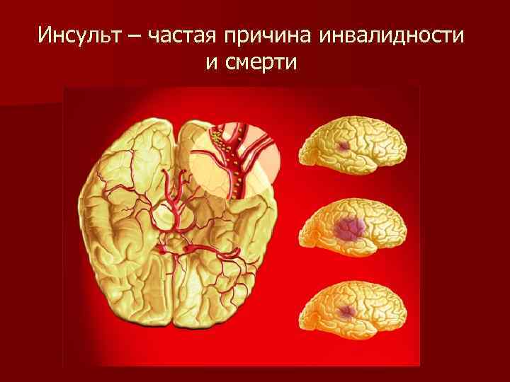 Инсульт – частая причина инвалидности и смерти 