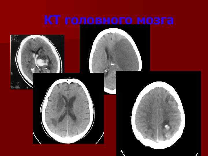 КТ головного мозга 