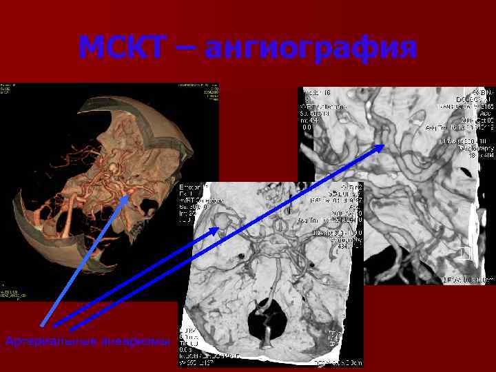 МСКТ – ангиография Артериальные аневризмы 