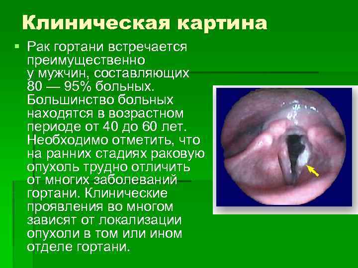 Клиническая картина § Рак гортани встречается преимущественно у мужчин, составляющих 80 — 95% больных.