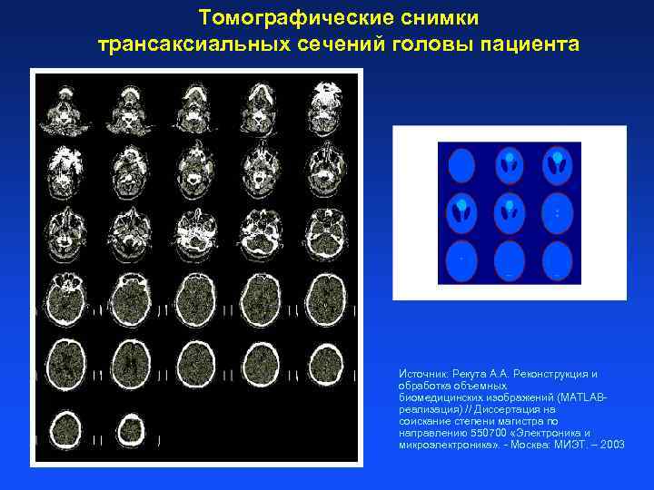 Томографические снимки трансаксиальных сечений головы пациента Источник: Рекута А. А. Реконструкция и обработка объемных