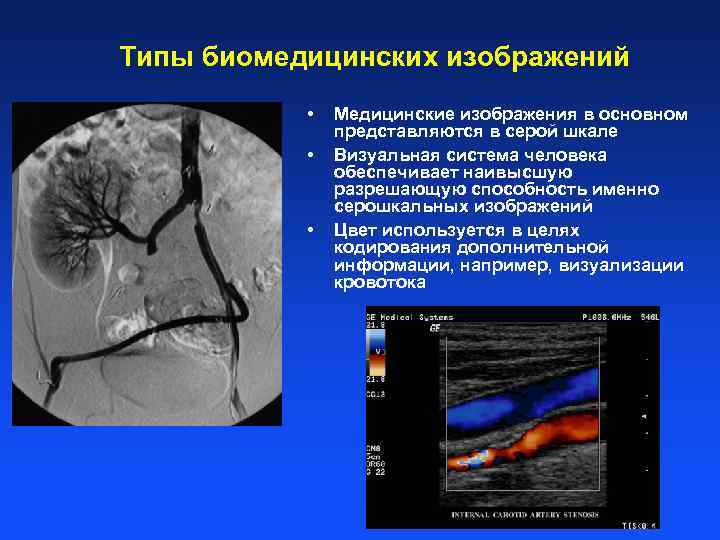 В серошкальном изображении гиперденсный участок