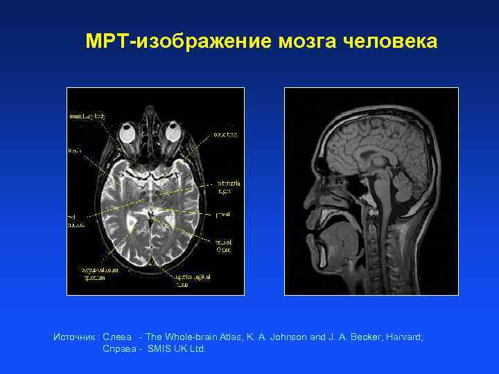 МРТ-изображение мозга человека Источник : Слева - The Whole-brain Atlas, K. A. Johnson and