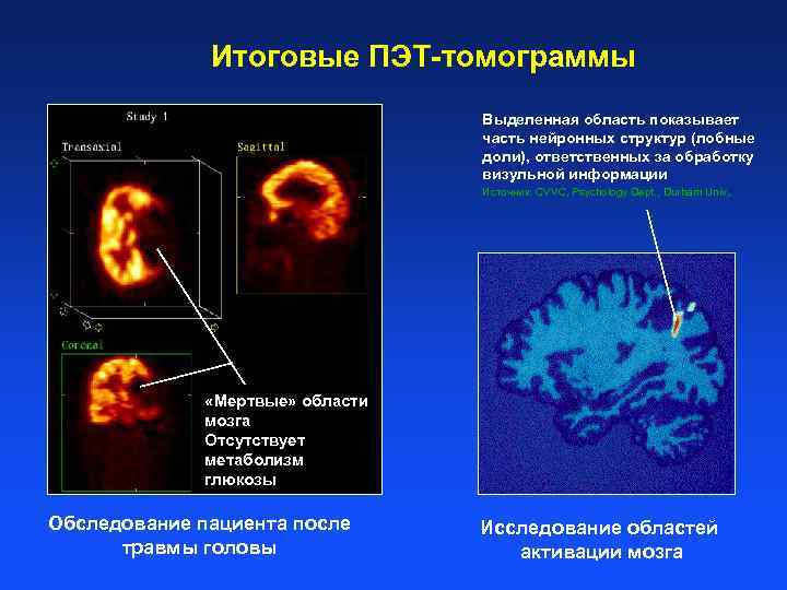 Итоговые ПЭТ-томограммы Выделенная область показывает часть нейронных структур (лобные доли), ответственных за обработку визульной