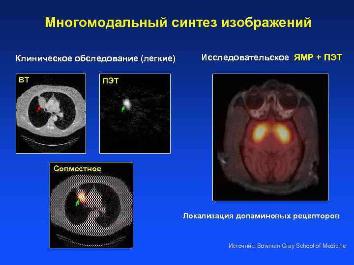 Многомодальный синтез изображений Клиническое обследование (легкие) ВТ Исследовательское ЯМР + ПЭТ Совместное Локализация допаминовых