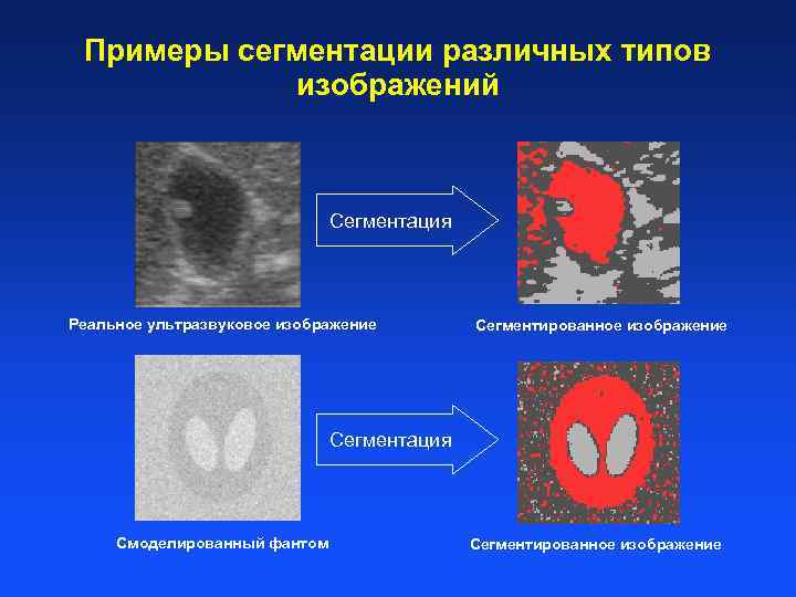 Примеры сегментации различных типов изображений Сегментация Реальное ультразвуковое изображение Сегментированное изображение Сегментация Смоделированный фантом