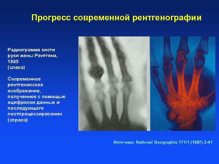 Прогресс современной рентгенографии Радиограмма кисти руки жены Рентгена, 1895 (слева) Современное рентгеновское изображение, полученное