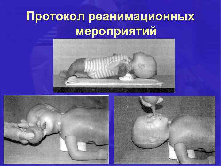 Протокол реанимационных мероприятий при асфиксии 