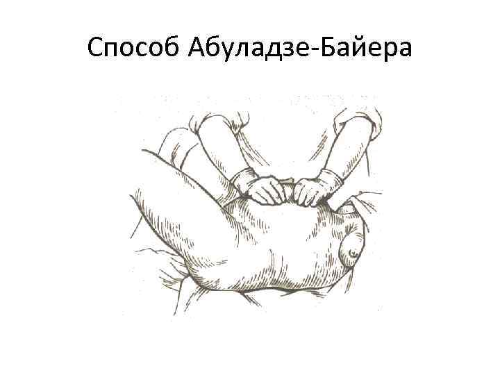 Способ Абуладзе-Байера 