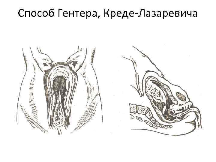 Способ Гентера, Креде-Лазаревича 