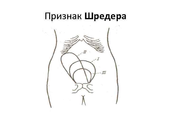 Признак Шредера 