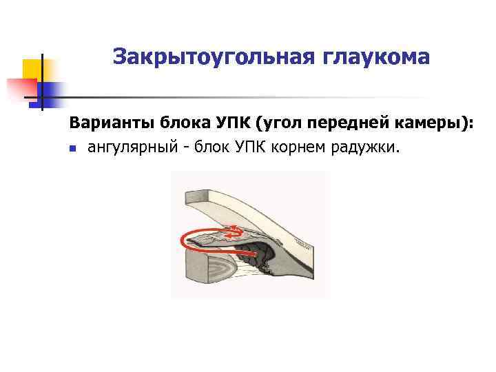 Закрытоугольная глаукома Варианты блока УПК (угол передней камеры): n ангулярный - блок УПК корнем