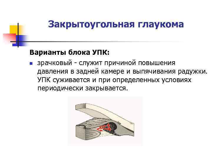 Закрытоугольная глаукома Варианты блока УПК: n зрачковый - служит причиной повышения давления в задней
