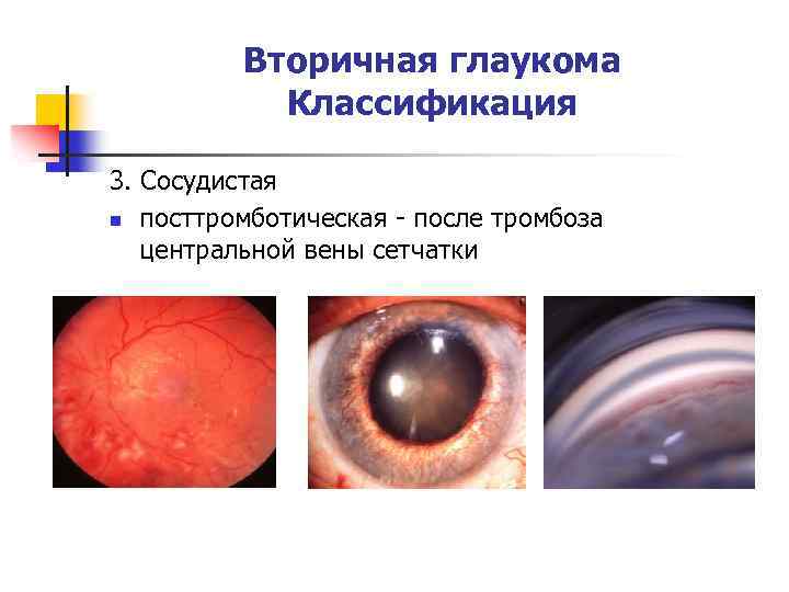 Вторичная глаукома Классификация 3. Сосудистая n посттромботическая - после тромбоза центральной вены сетчатки 