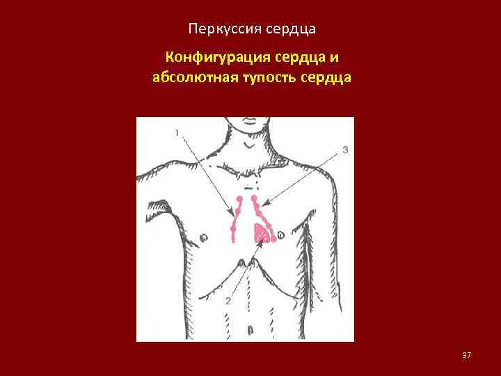 Определение сердечной тупости. Перкуссия абсолютной тупости сердца. Перкуссия границ абсолютной тупости сердца. Перкуссия сердца границы абсолютной сердечной тупости. Сердечная тупость абсолютная норма патология.