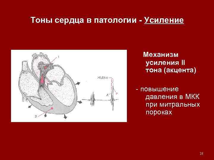 Тоны сердца в патологии - Усиление Механизм усиления II тона (акцента) - повышение давления