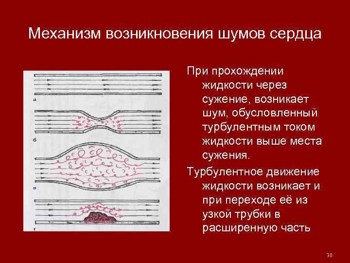 Механизм возникновения шумов сердца При прохождении жидкости через сужение, возникает шум, обусловленный турбулентным током