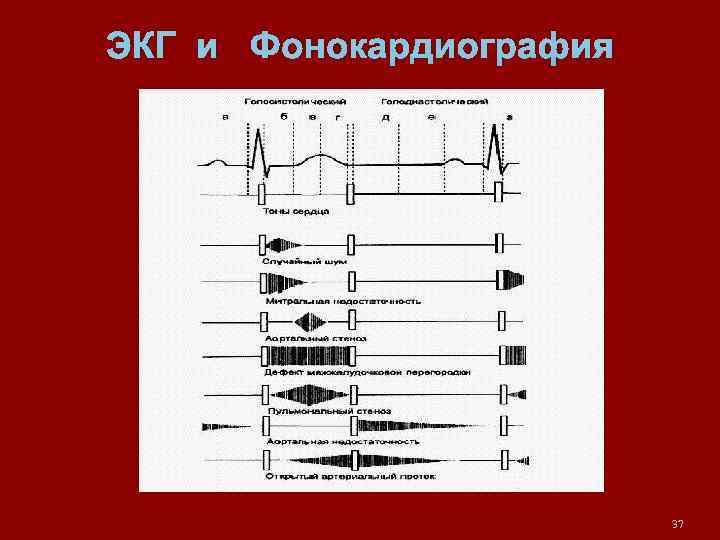 ЭКГ и Фонокардиография 37 