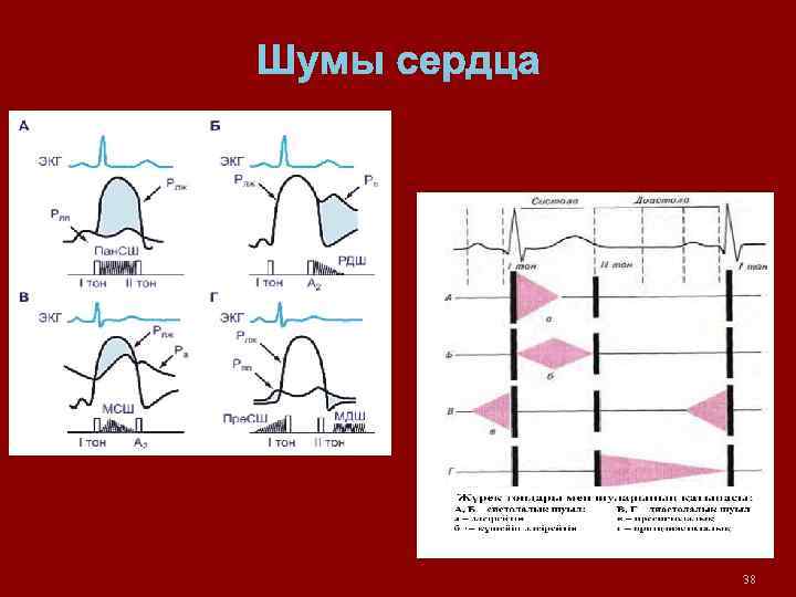 Шумы сердца 38 