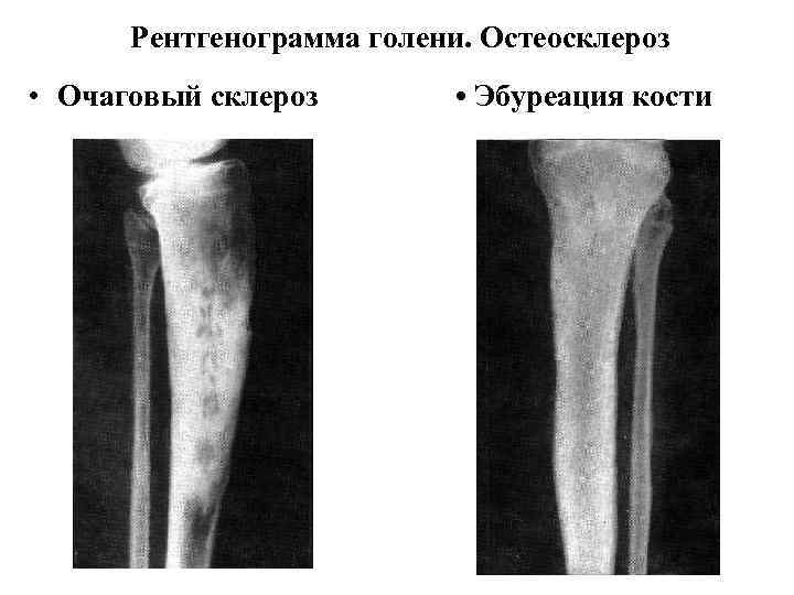 Остеосклероз подвздошной кости симптомы и признаки с фото