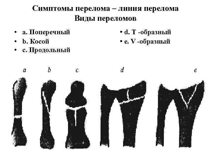 У образный перелом схема