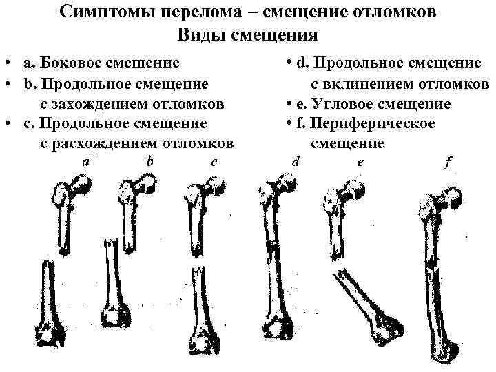 Смещение отломков кости